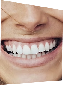 Blanchiment dentaire