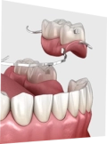 Zahnprothese