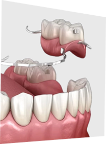 Zahnprothese