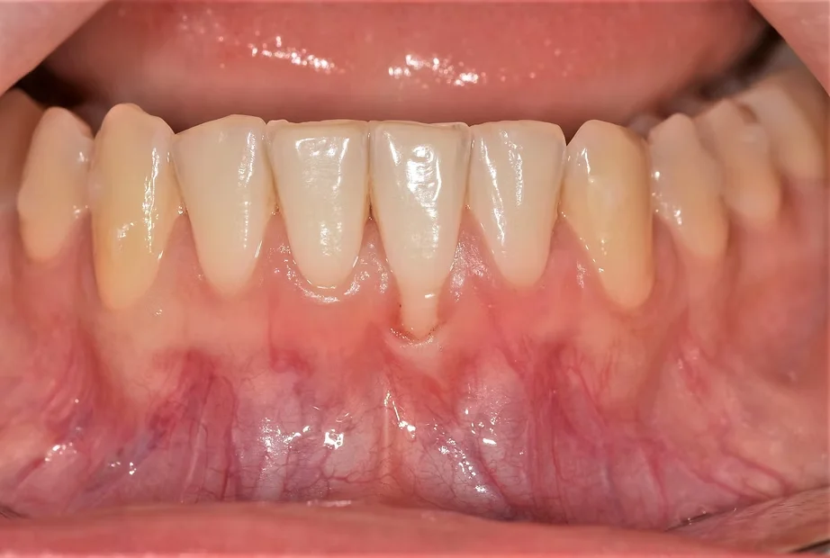 Zahnästhetik durch Zahnfleischtransplantation&nbsp;
